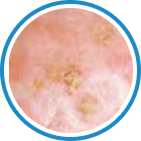 Aktinik Keratoz kriyoterapi tedavisi