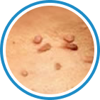 Et Beni (Acrochordon) kriyoterapi tedavisi