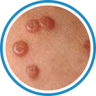 Molluscum Contagiosum kriyoterapi tedavisi