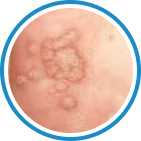 Verruca Vulgaris — Siğil kriyoterapi tedavisi